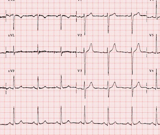 EKG - Elektrokardiyogram (Kalp Akım Grafiği) 2 ekg elektrokardiyogram otm