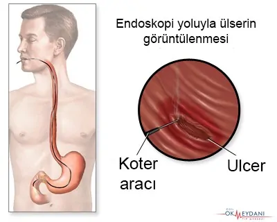 Mide Ülseri 5 mide ulseri edoskopi koter
