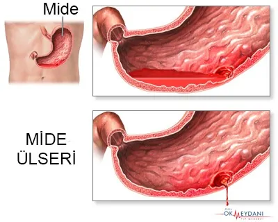 Mide Ülseri 3 mide ulseri semtomlari belirtileri otm