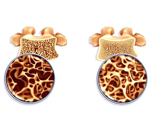 Osteoporoz (Kemik Erimesi) 3 osteoporoz hastaligi otm