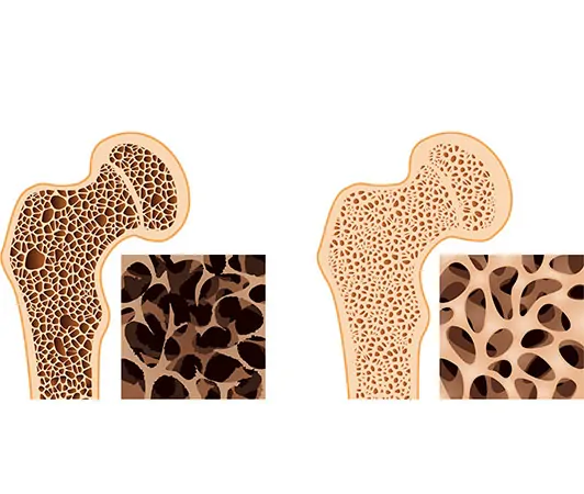 Osteoporoz (Kemik Erimesi) 4 osteoporoz kemik erimesi otm