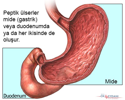 Mide Ülseri 2 mide ulseri peptik ulserler
