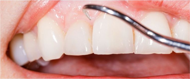 periodontoloji-tedavisi